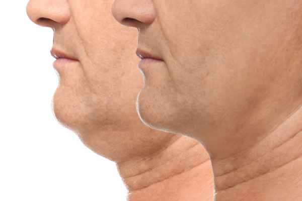 HIFU - Breakthrough in Anti - ageing 2 hifu results Crawley