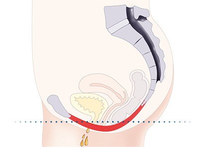 Pelvic-Floor Muscle Repair 5 Pelvic floor muscles Crawley