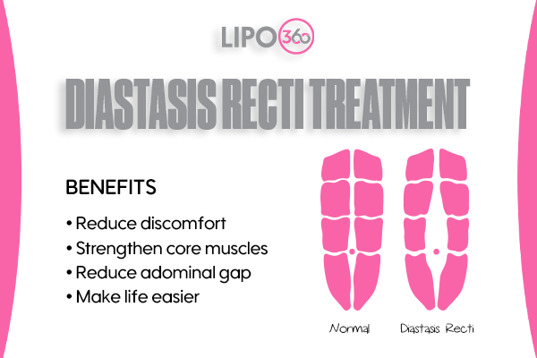 Revolutionising Muscle Repair: The Power of LIPO360 Body Sculpt Post-Injury 5 diastasis recti treatment Crawley