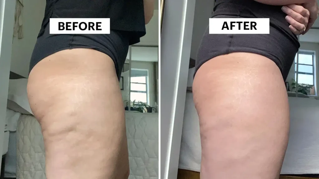 Do Toning Exercise Crawley Really Tackle Cellulite?
