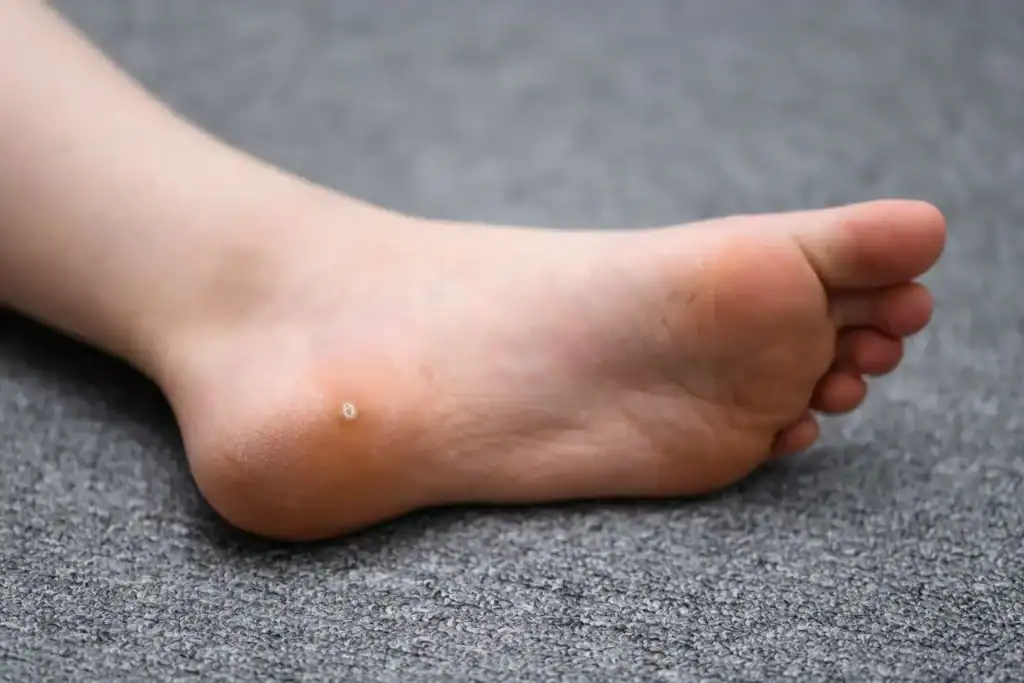 Cryotherapy For Warts And Also Verrucas 2 Image of verruca on the bottom of the foot that able to be treated with Cryotherapy Crawley