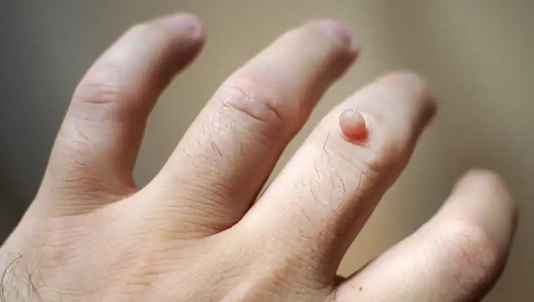 Image of blemish that Cryotherapy Crawley can remove with Lipo 360.