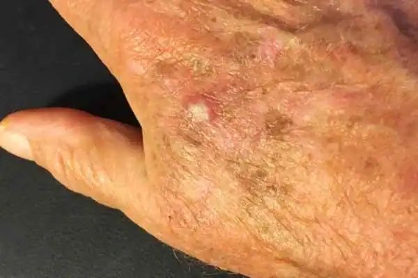 Image of Actinic keratoses Crawley on a person hand