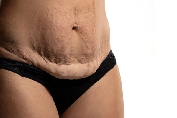 The science behind skin tightening Crawley picture of a woman's sagging skin on the stomach